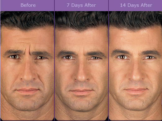 Before & After ⋆ drten20