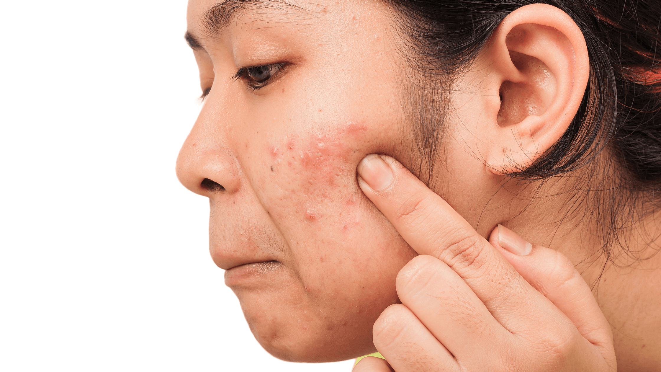 Common Hormonal Imbalances that Cause Acne Dr Terry Loong