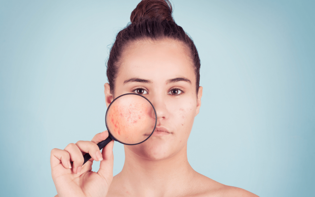 6 Skin Conditions that Look Like Acne But Isn’t Acne Dr Terry Loong