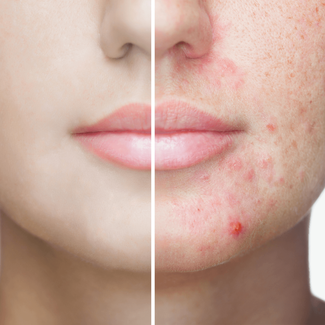 6 Skin Conditions that Look Like Acne But Isn’t Acne Dr Terry Loong