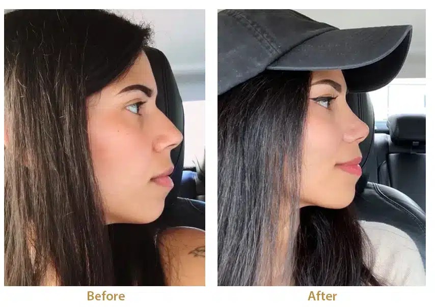 RHINOPLASTY vs NONSURGICAL NOSE JOB