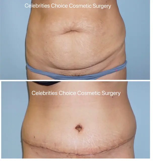 Tummy Tuck Orlando Mini Tummy Tuck or Full Tummy Tuck
