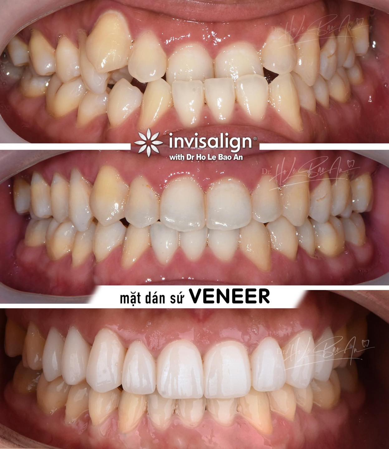 Invisalign Plus Veneer Masterpiece of Science and Art