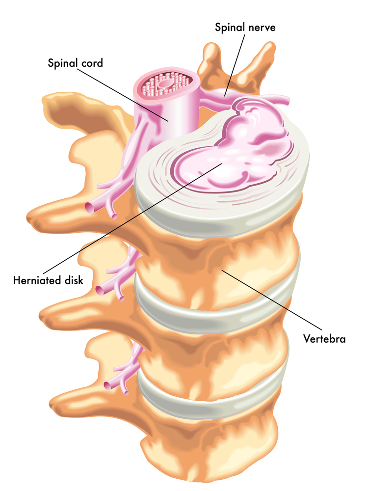 Herniated Disc Treatment Minimally Invasive Spine Surgery