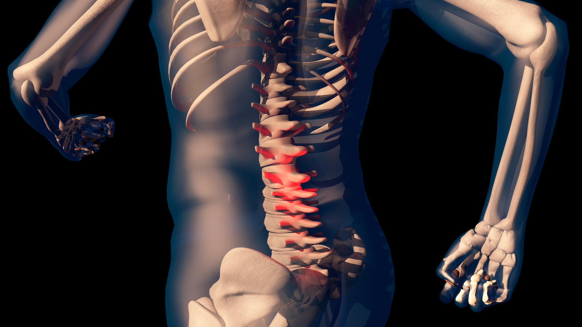 Dr. Mork in Newport Beach, CA Wants You To Reconsider Spinal Fusion Surgery