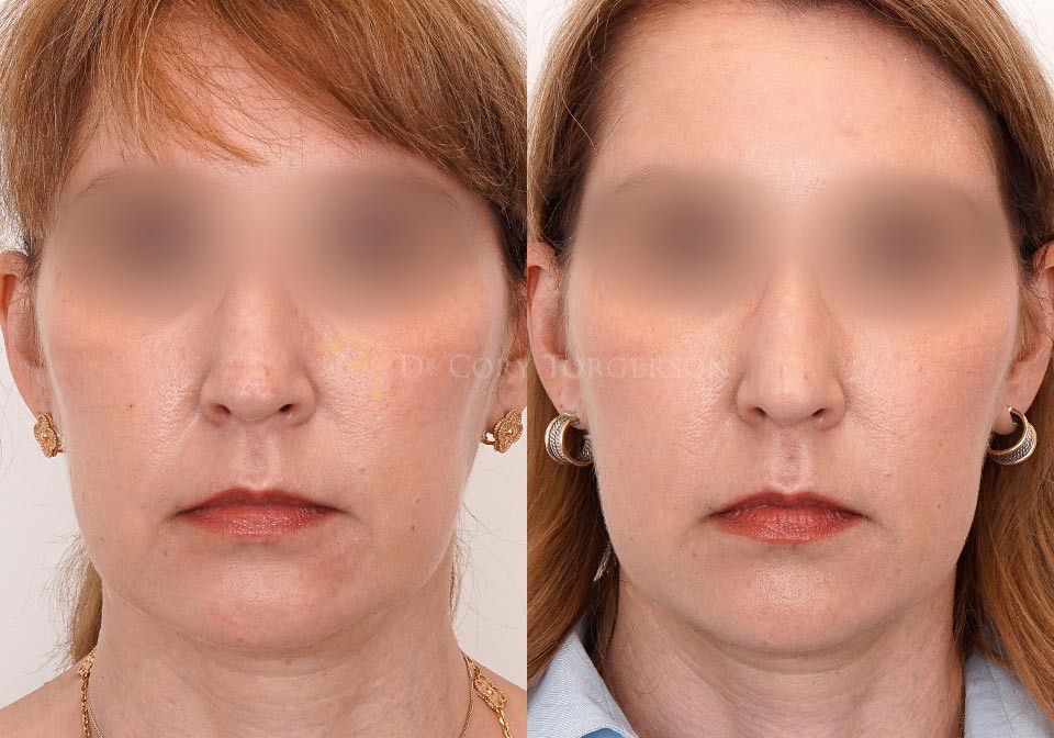 Thread Lift Before & After Gallery Dr. Cory