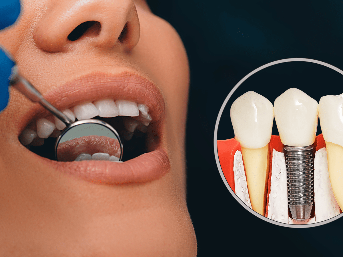 Debunking Common Misconceptions About Dental Implants Konstantine Trichas DDS, LLC