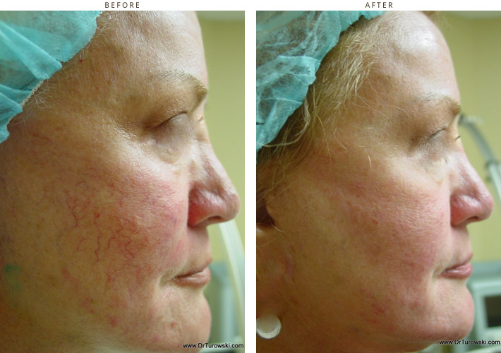 Intense Pulse Light (ipl) Before and After Pictures * Dr Turowski
