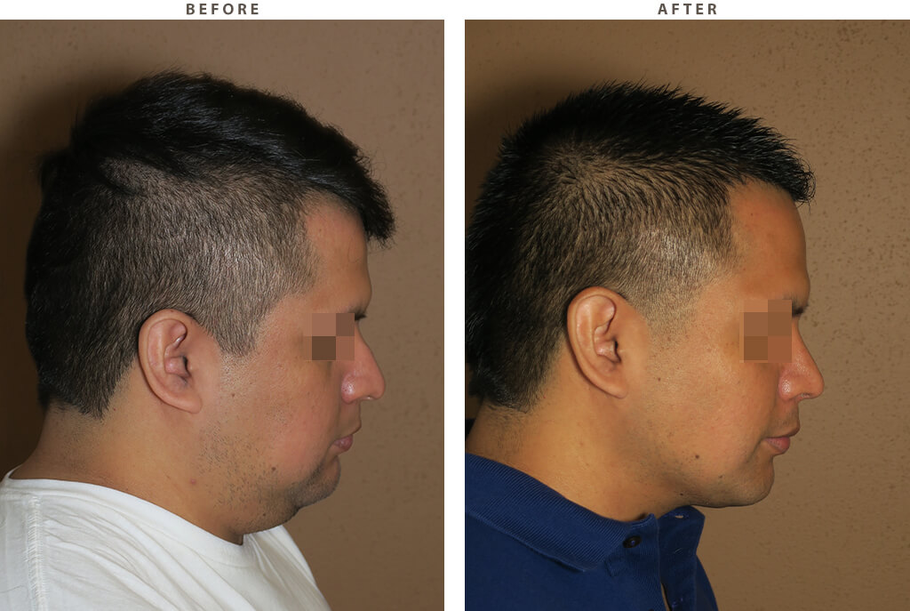 Liposuction of the neck Before and After Pictures * Dr
