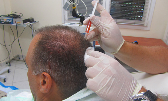 Platelet Rich Plasma (PRP) Treatment for Hair Restoration Chicago Dr