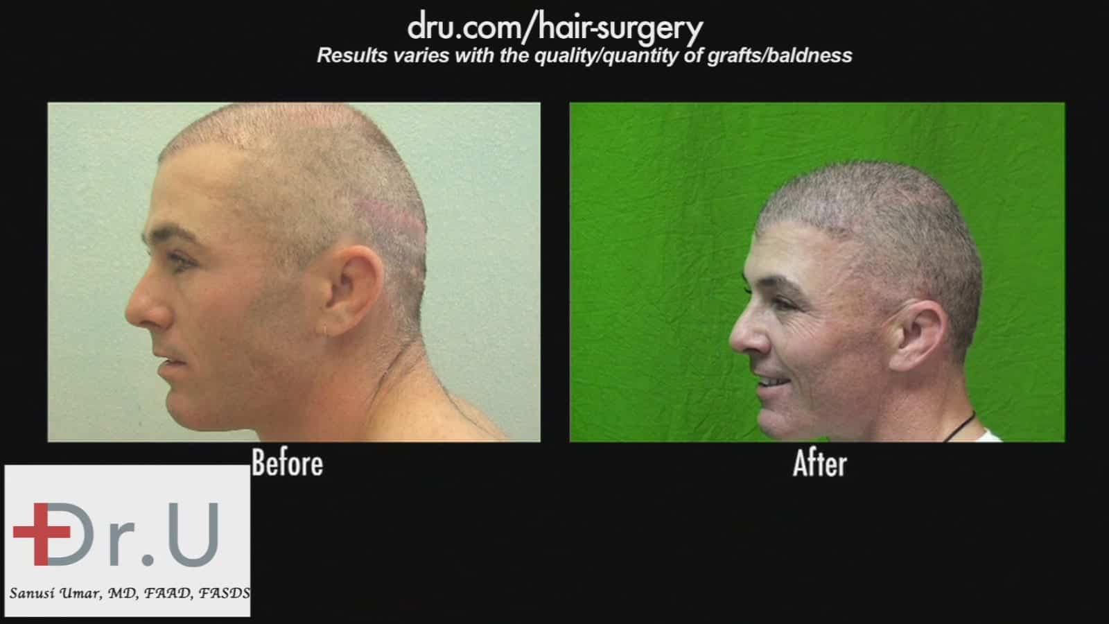 Video Hair Transplant Scar Revision Before and After Dr.UGraft