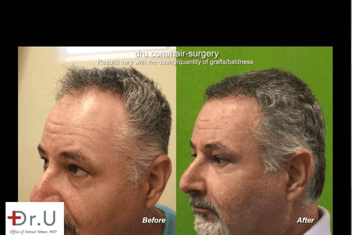 Patient Results Gallery, Dr U Hair Clinic Los Angeles