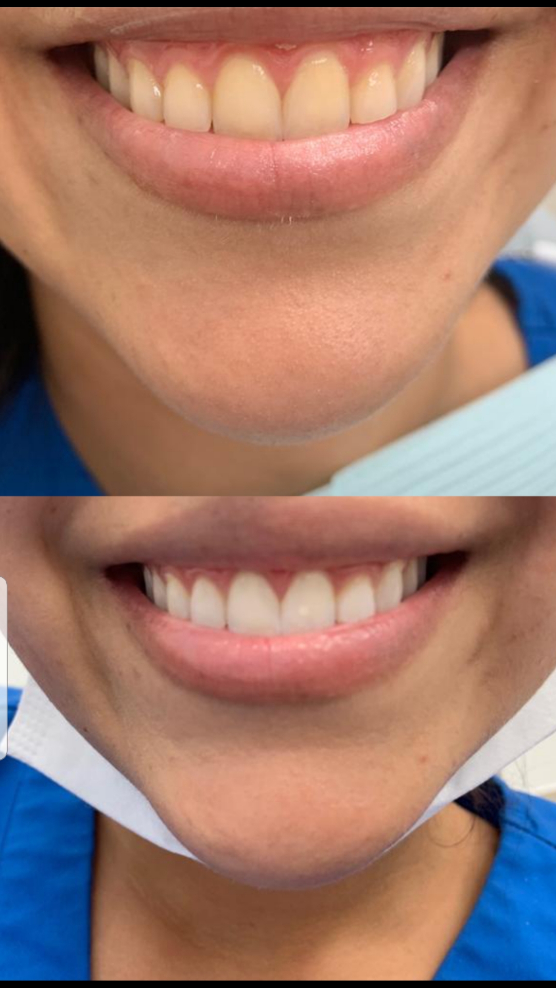 Teeth Whitening Miami and North Miami Beach, FL Drubi Dental