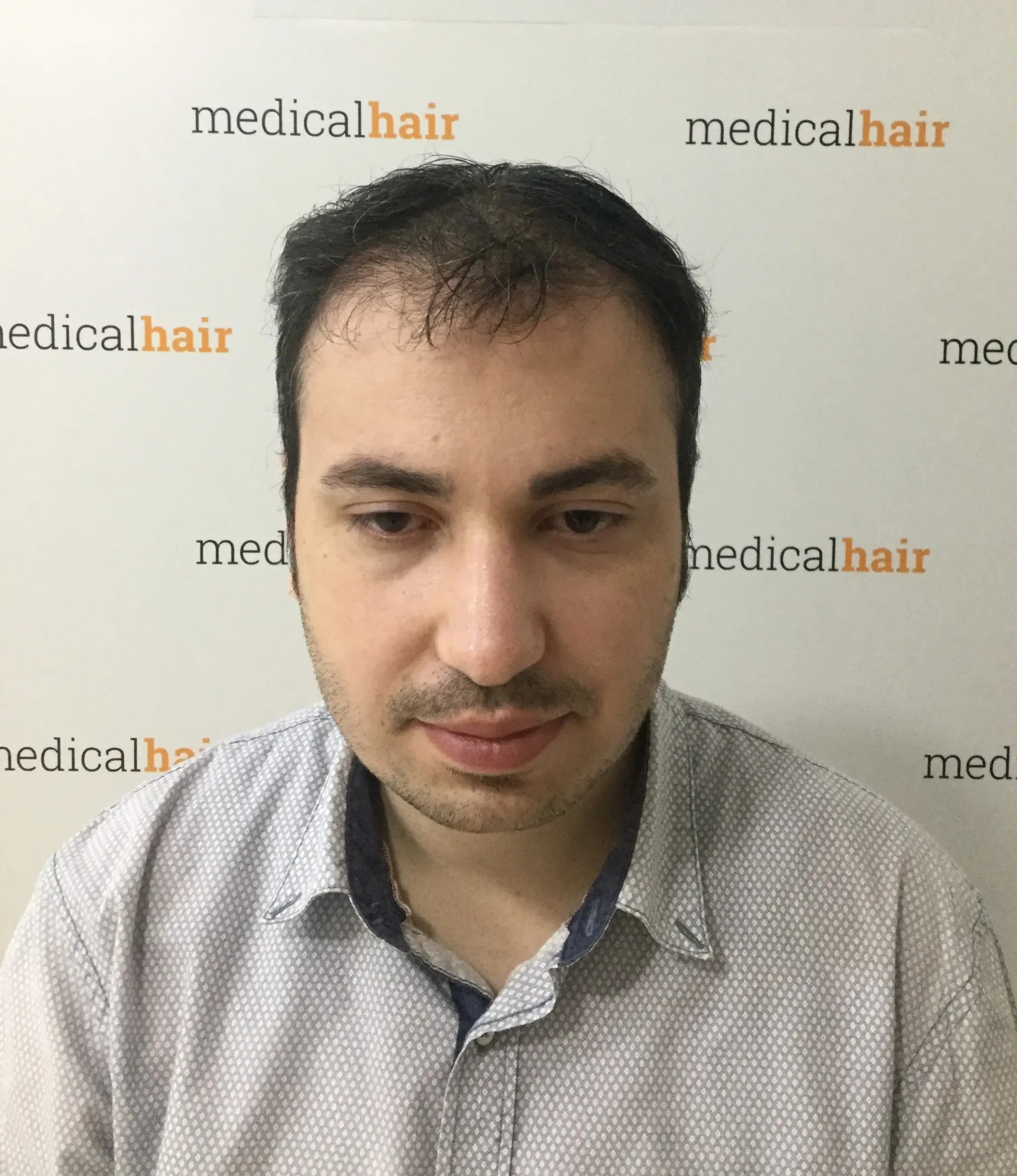 Before and Afters Dr. Ulusan Medical Hair Clinic