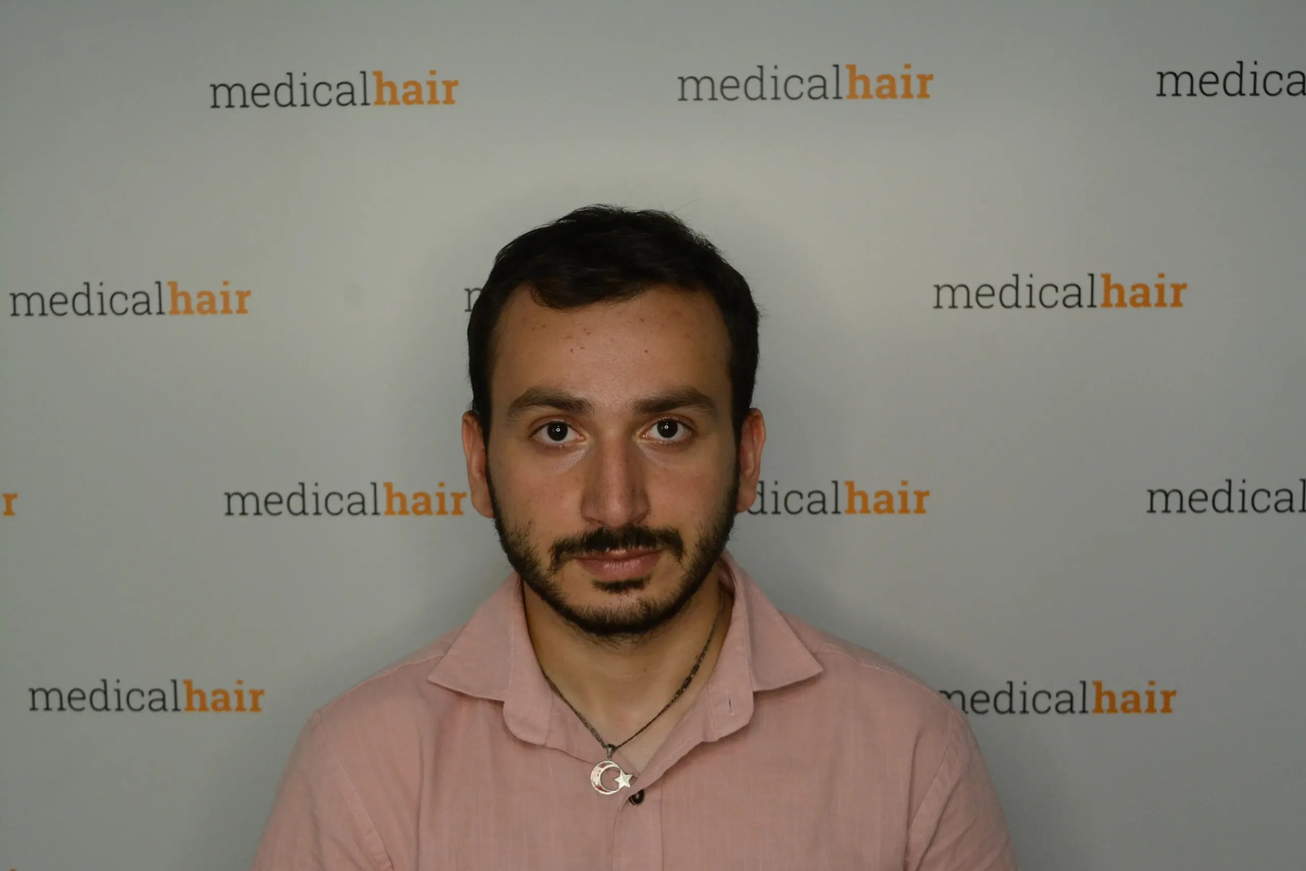 Before and Afters Dr. Ulusan Medical Hair Clinic