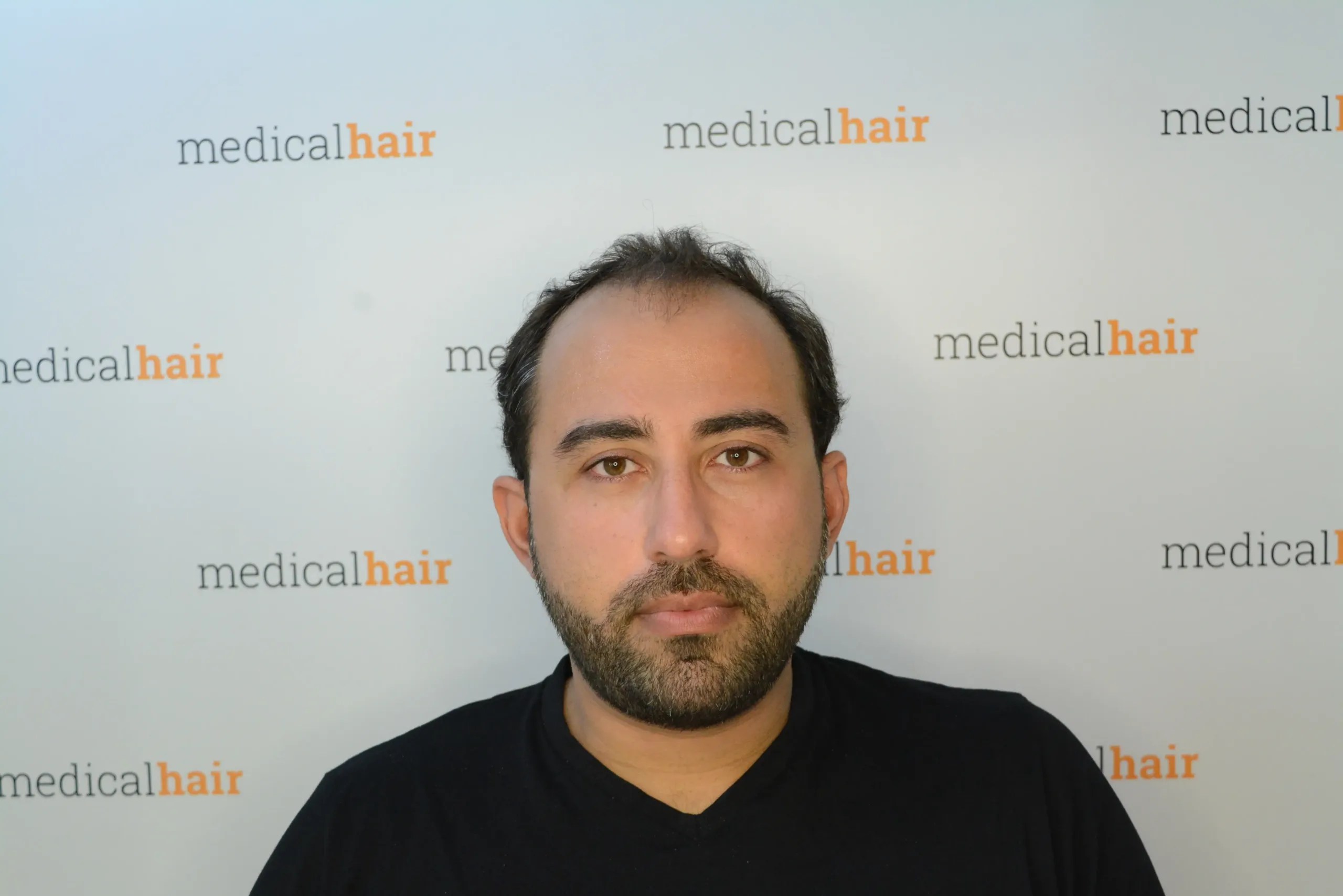 Before and Afters Dr. Ulusan Medical Hair Clinic