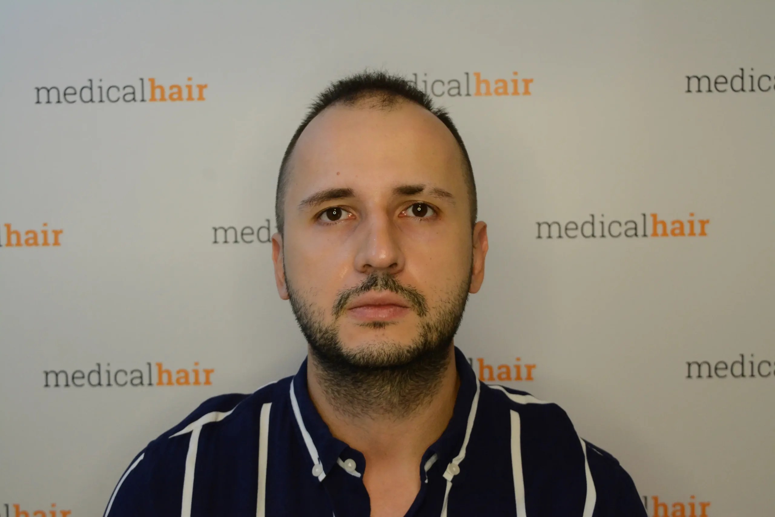 Dr. Ulusan FUE Dr. Ulusan Medical Hair Clinic