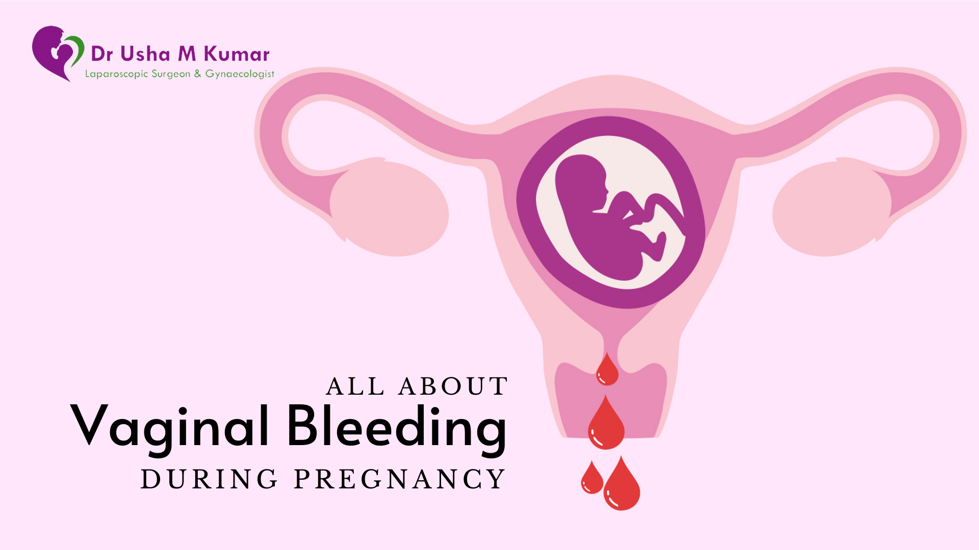 Best Gynecologist in Delhi Vaginal bleeding during pregnancy