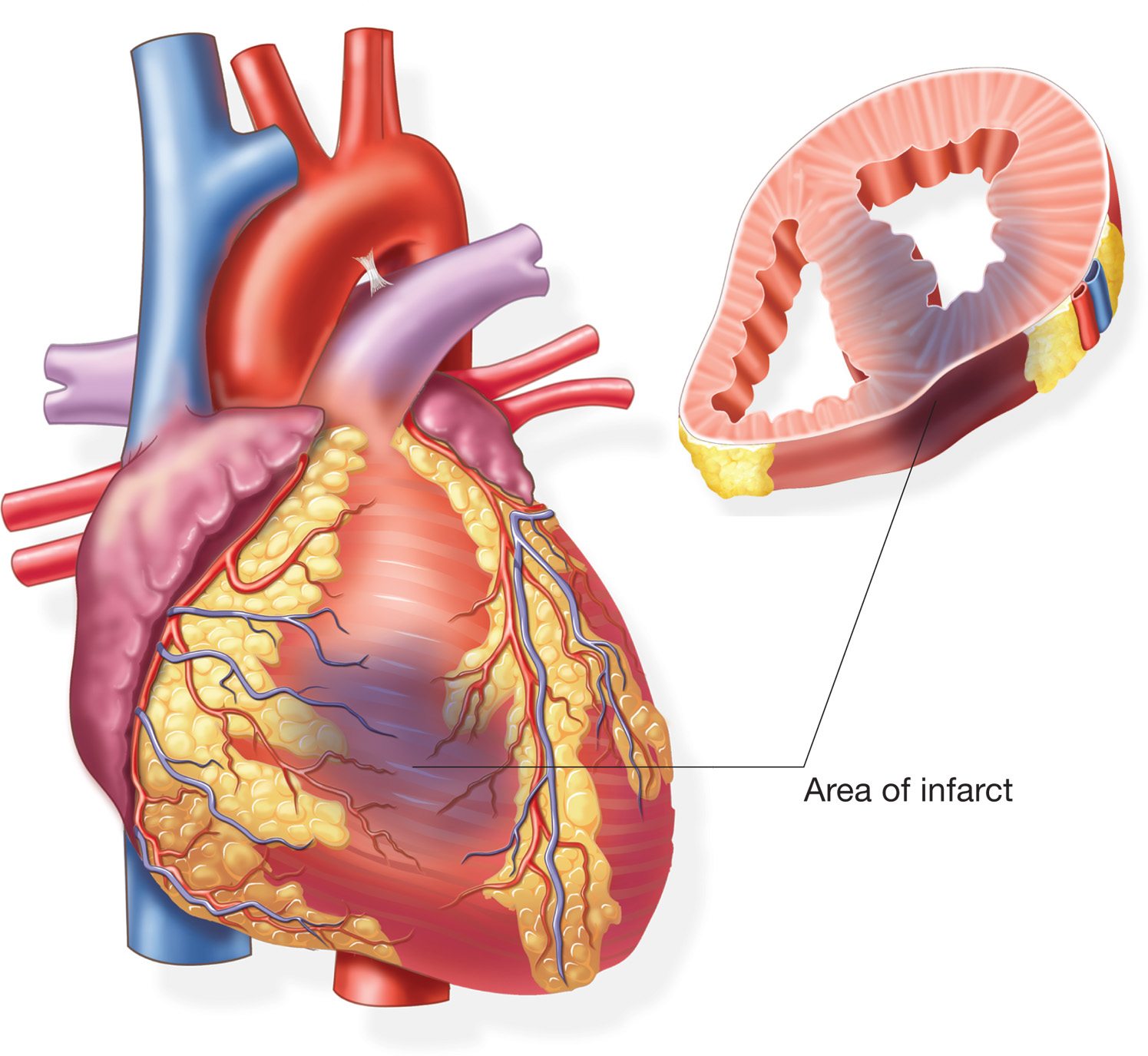 Heart Attack Valentino Cardiology Specialists Heart Attack Valentino Cardiology Specialists