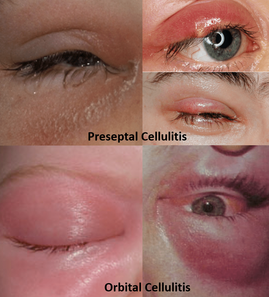 Swollen Eyelid Know the causes, remedies and alert signs