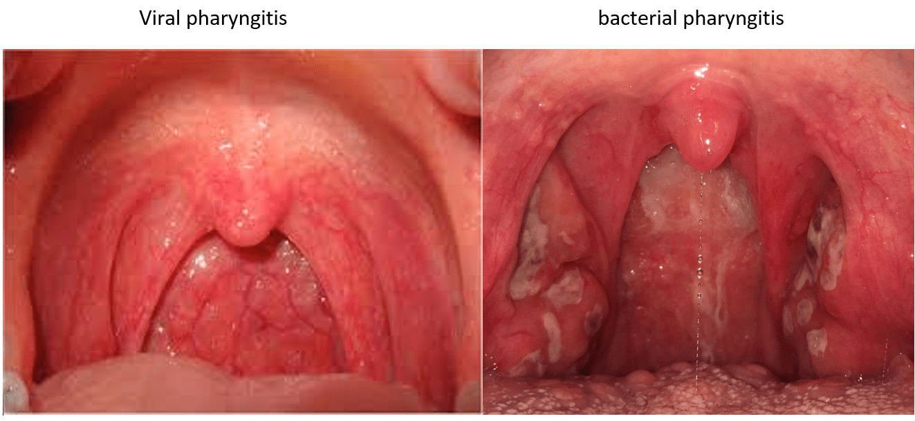 Sore throat Causes, Symptoms and Health measures