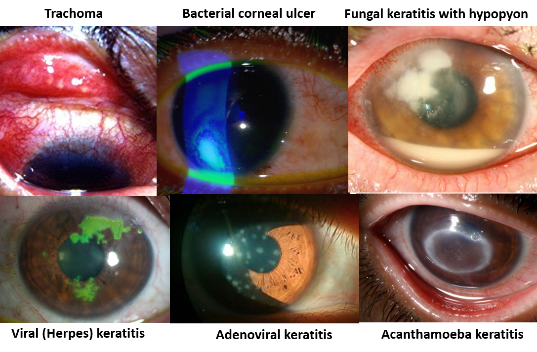 Red Eyes Keratitis and Scleritis