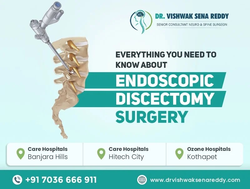 Everything You Need to Know About Endoscopic Discectomy Surgery