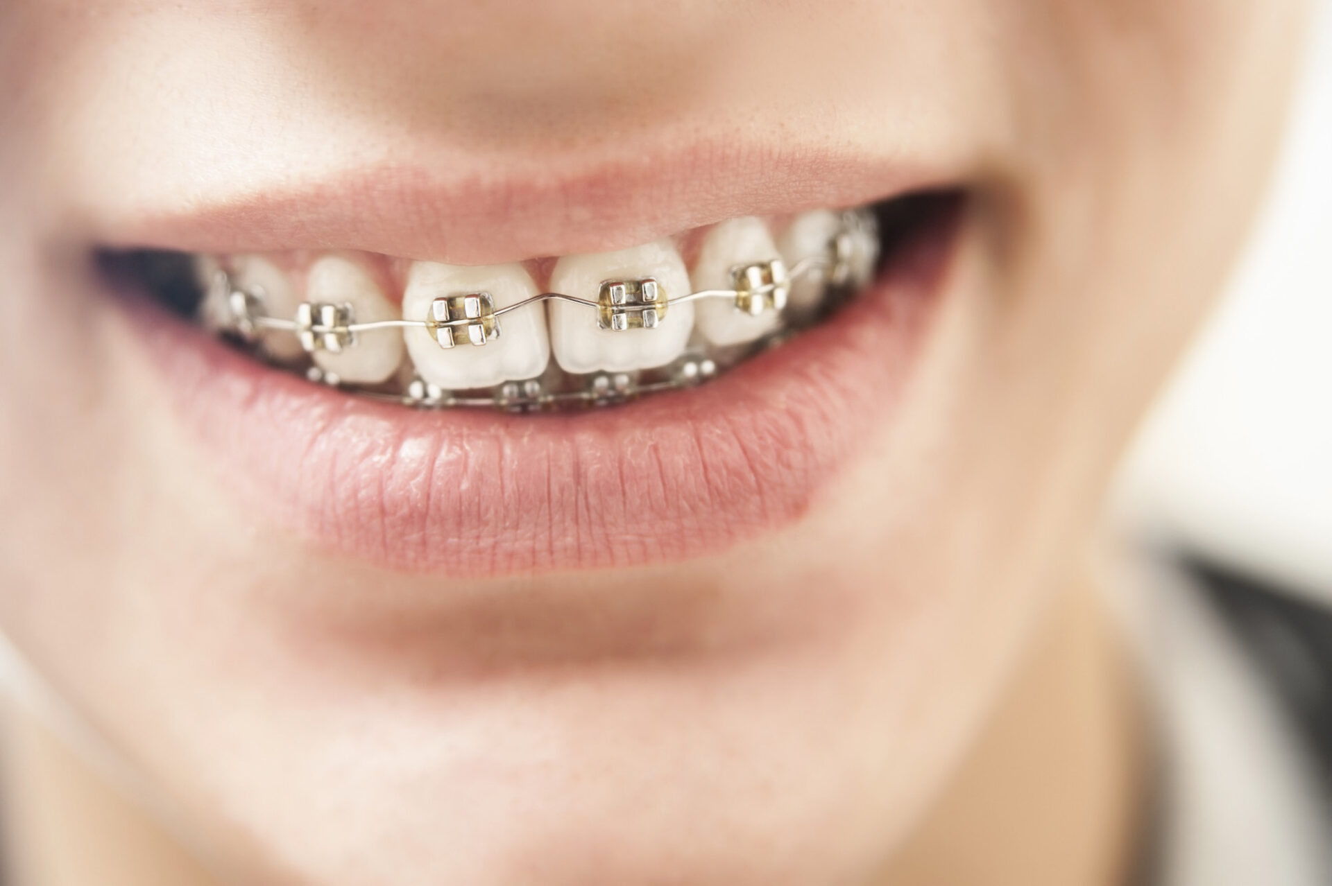 Metal vs Ceramic Braces Which Smile Solution is Right for You?