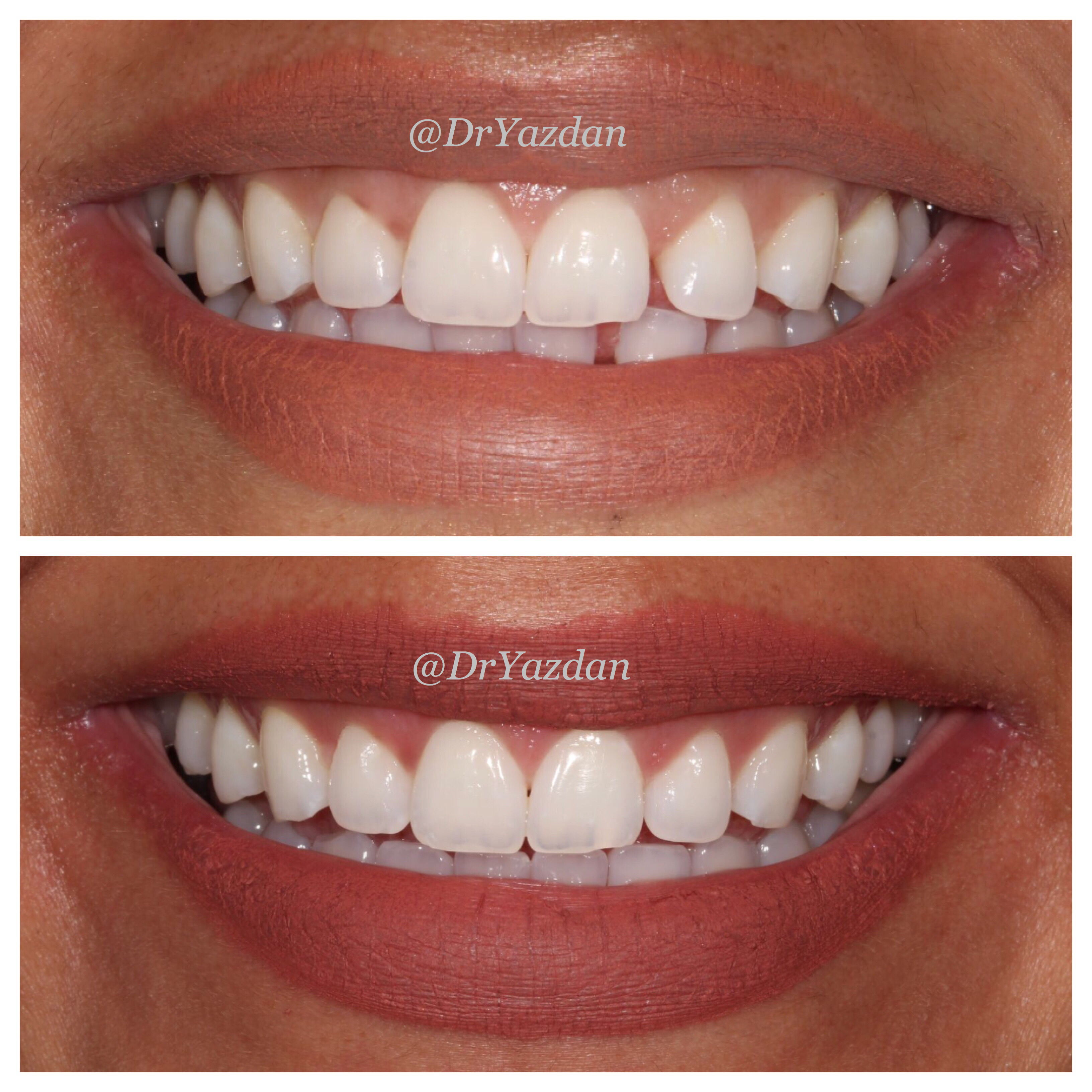 What Will I Look Like With Straight Teeth TeethWalls