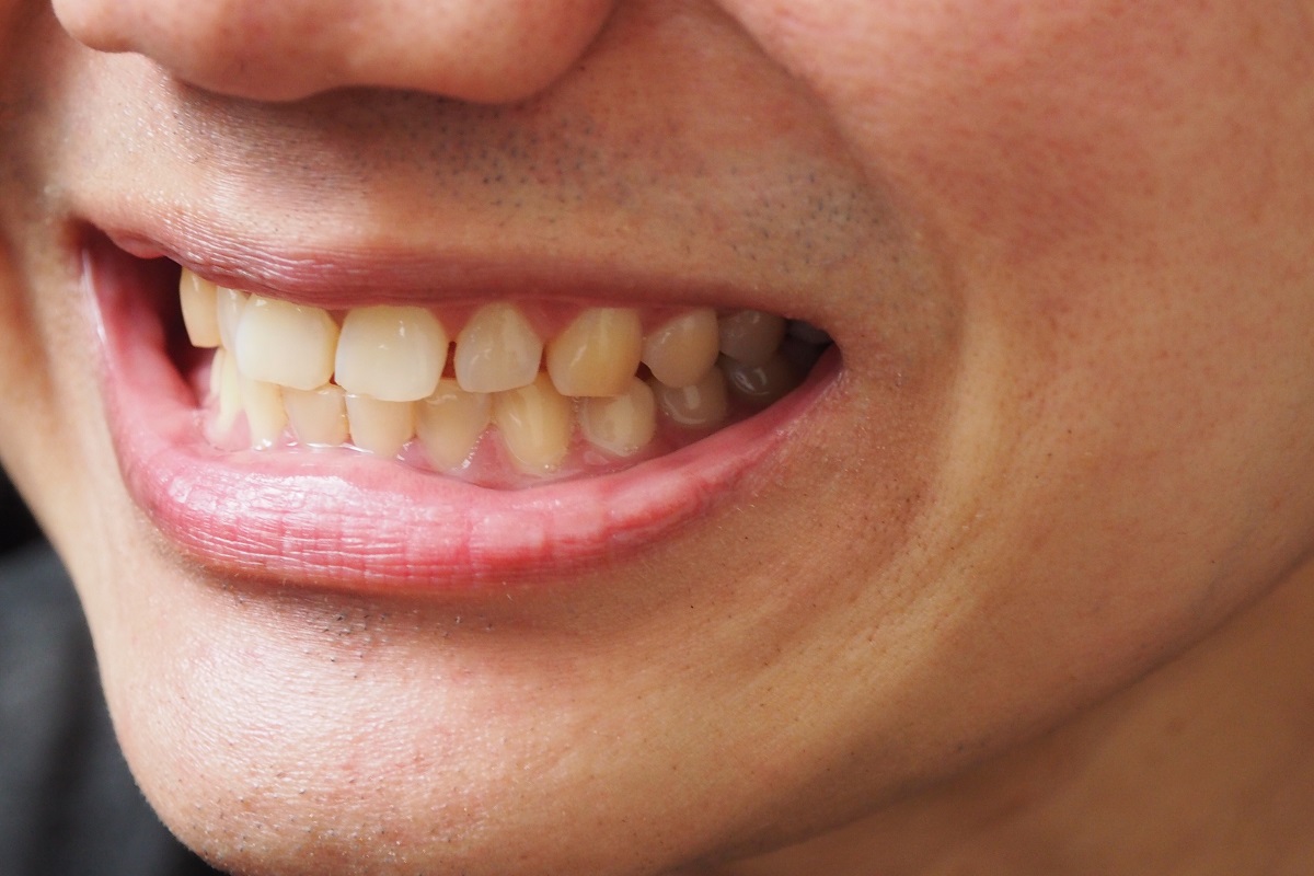 Top 10 Causes of Tooth Stain Center for Restorative & Cosmetic Dentistry