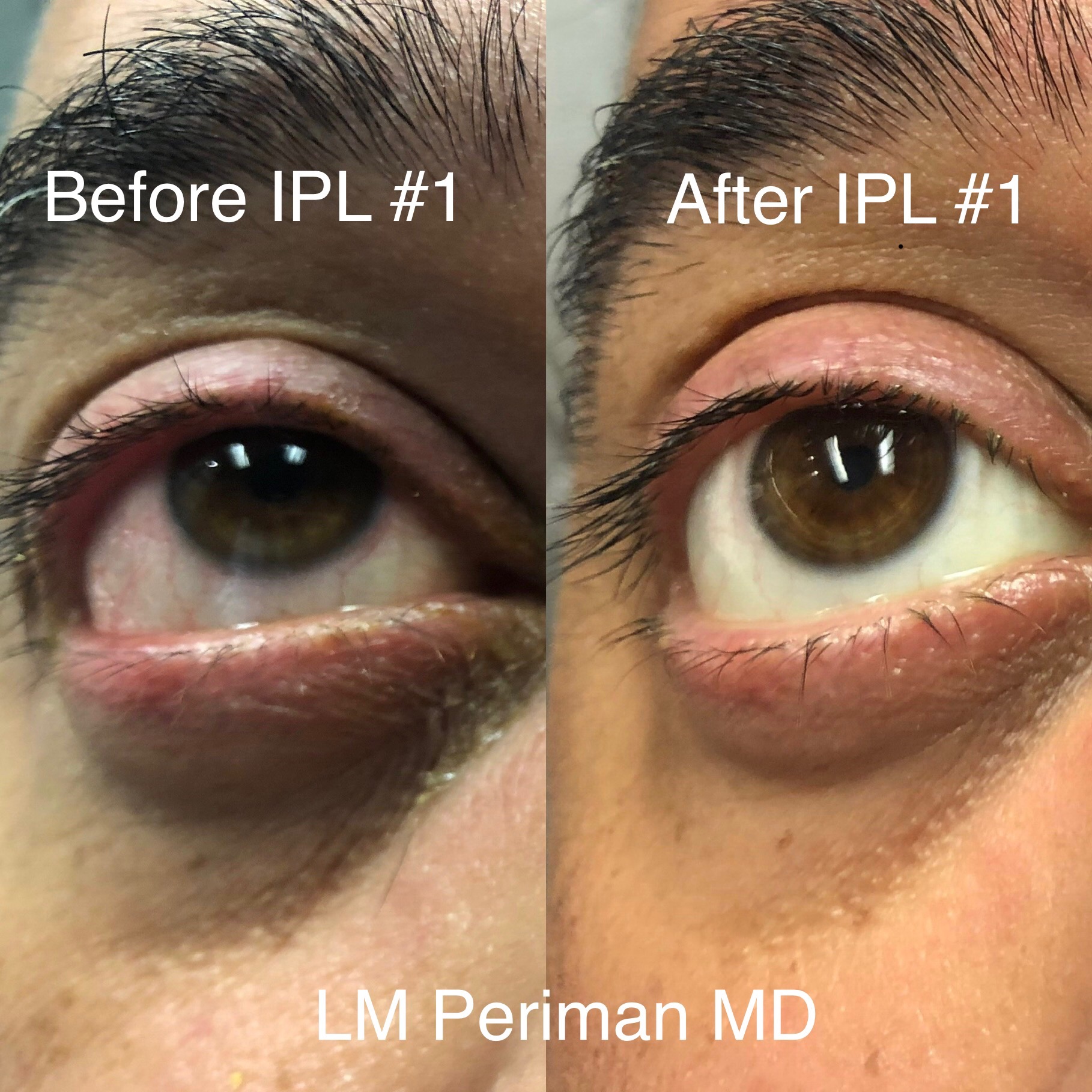 IPL Dry Eye Master
