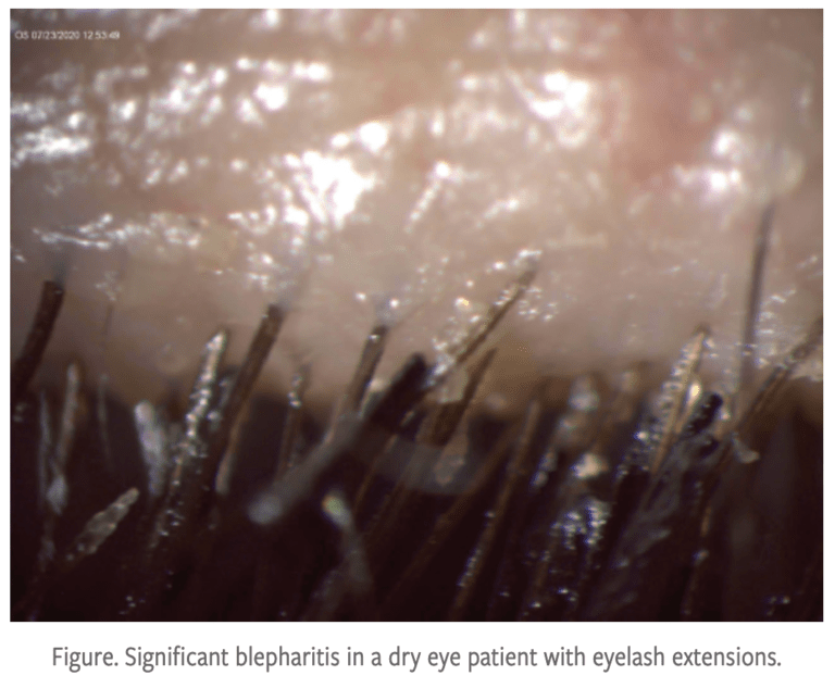 blepharitiseyelashextensions Dry Eye Master