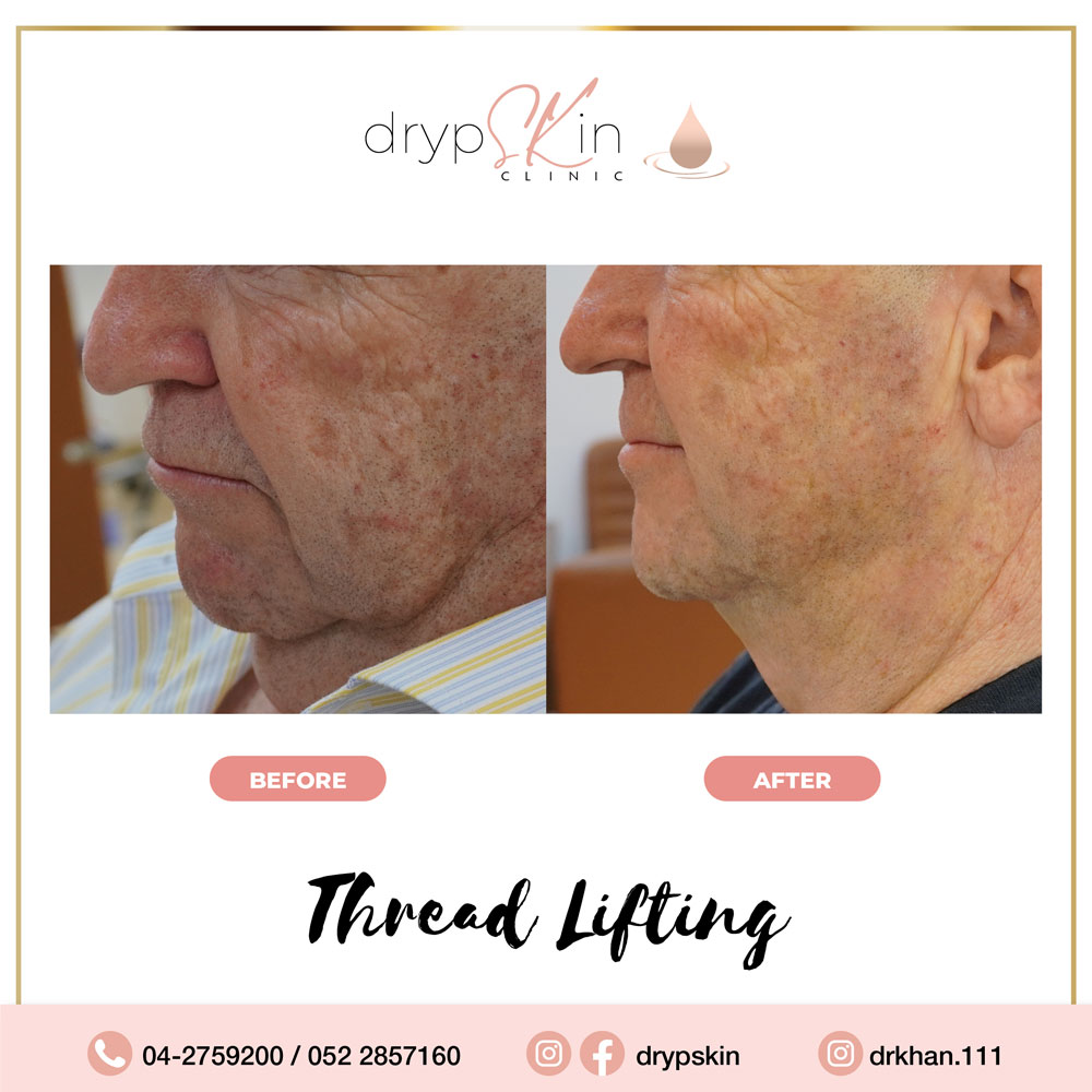 Thread lift Dubai PDO Thread Lift Drypskin