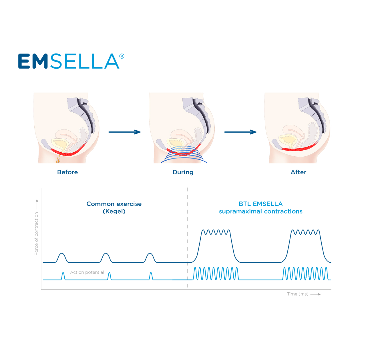 Emsella HIFEM That Targets the PelvicFloor Dr Yusra