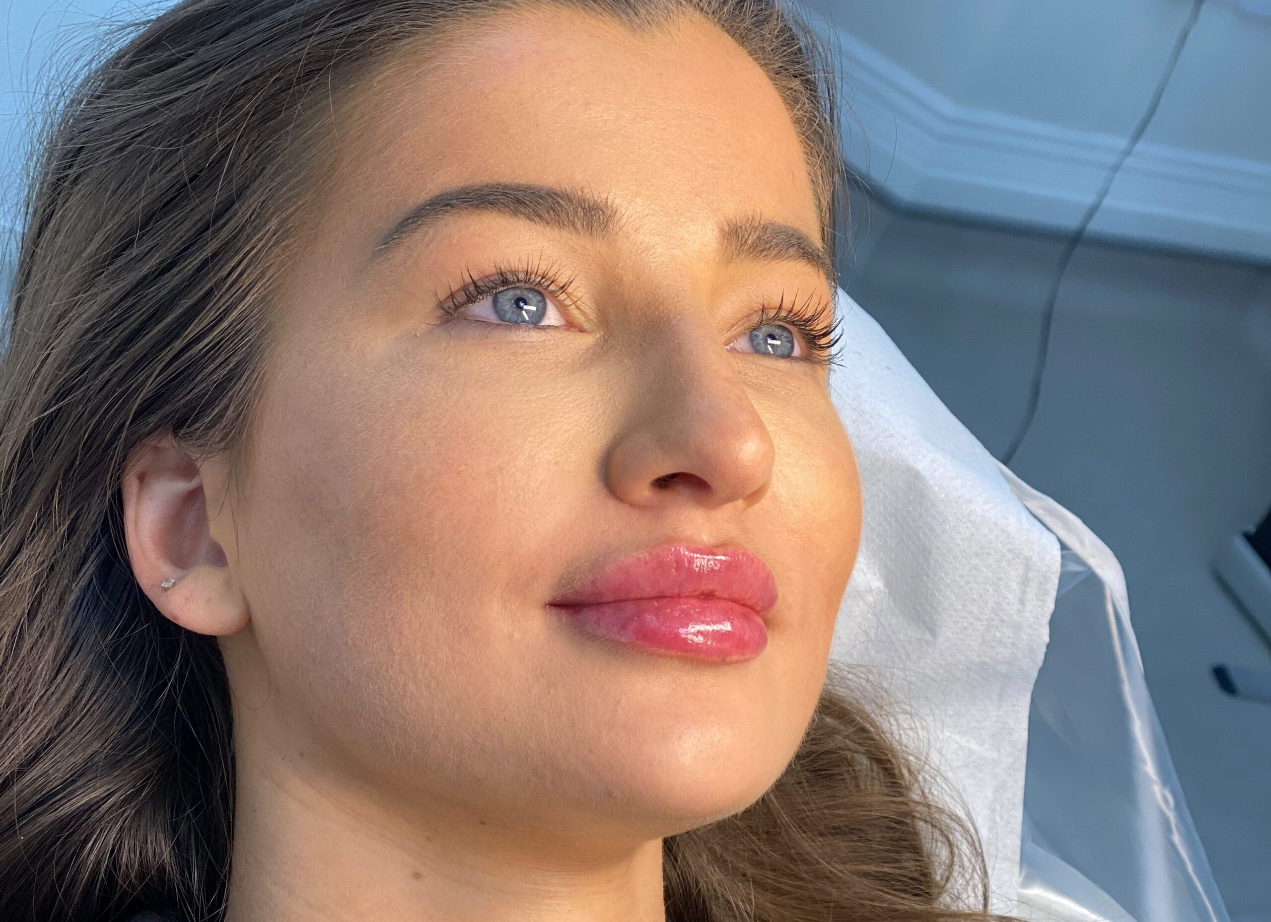 Lip Filler Treatment Lip Fillers Dr Yusra Clinics