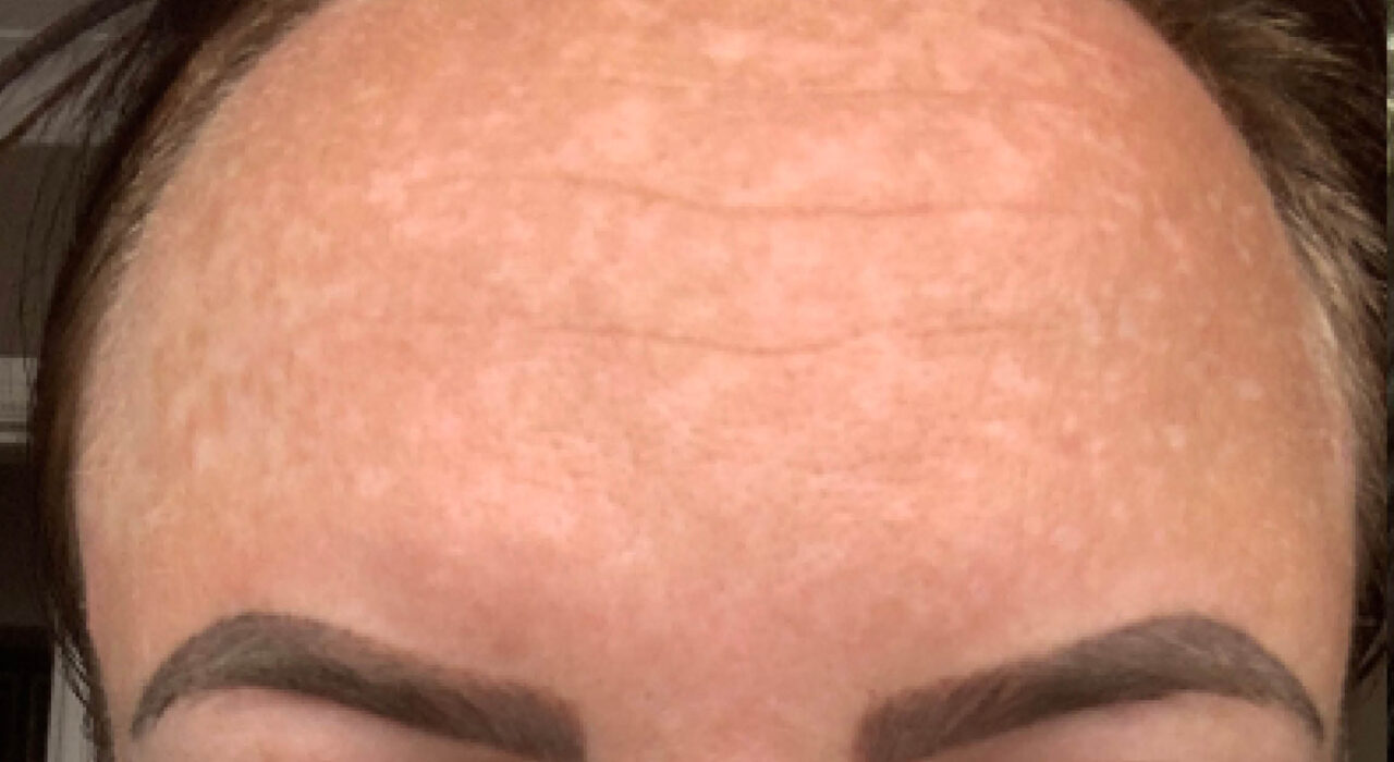 Hyperpigmentation Treatments Dark Spots on Skin Dr Yusra