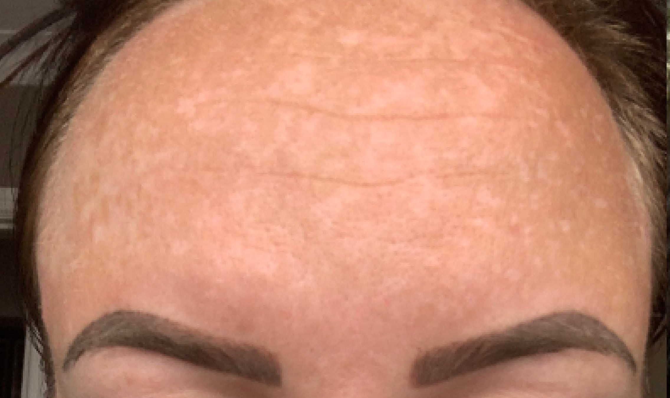 Hyperpigmentation Treatments Dark Spots on Skin Dr Yusra
