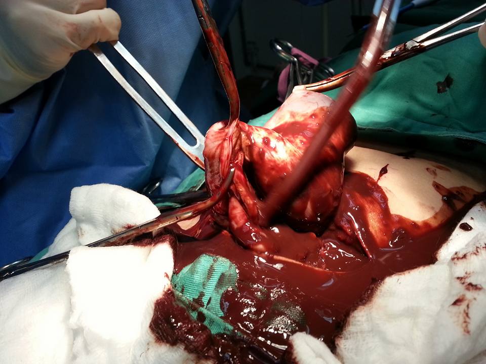 endometriosis adalah peyakit akibat keradangan dan ketidakseimbangan