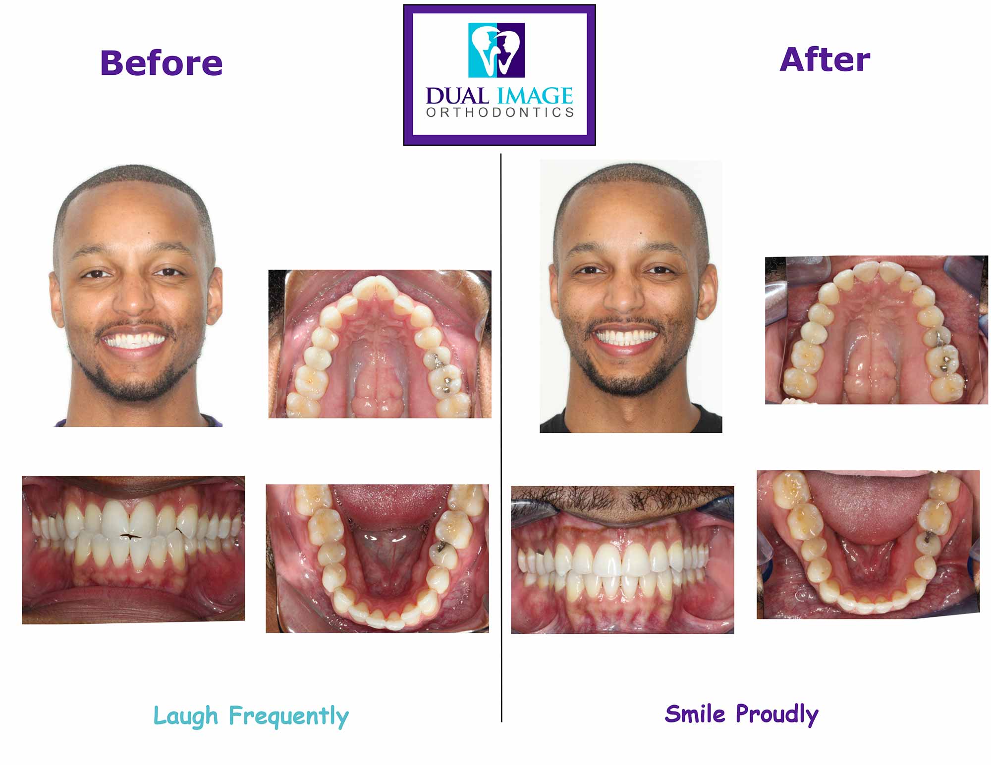 Crossbite Braces Before After