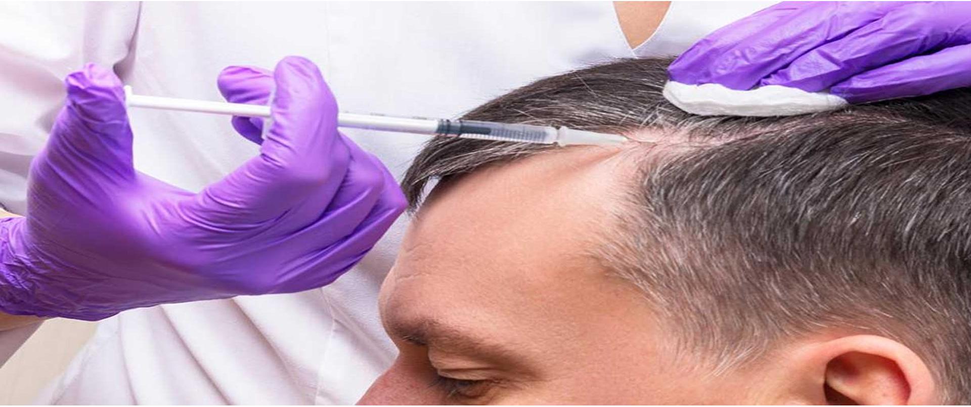 PRP Treatment For Hair Loss in Dubai Affordable Aesthetic Clinic in