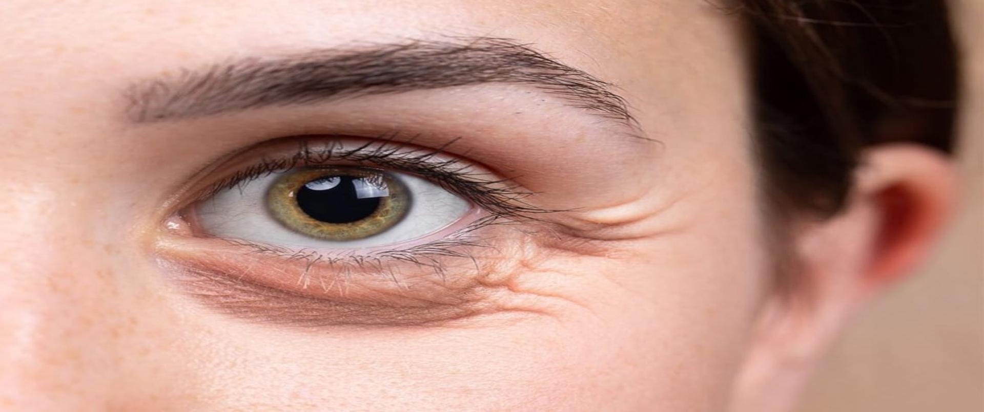 Eye Bag Removal Treatment Dubai Affordable Aesthetic Clinic in Dubai