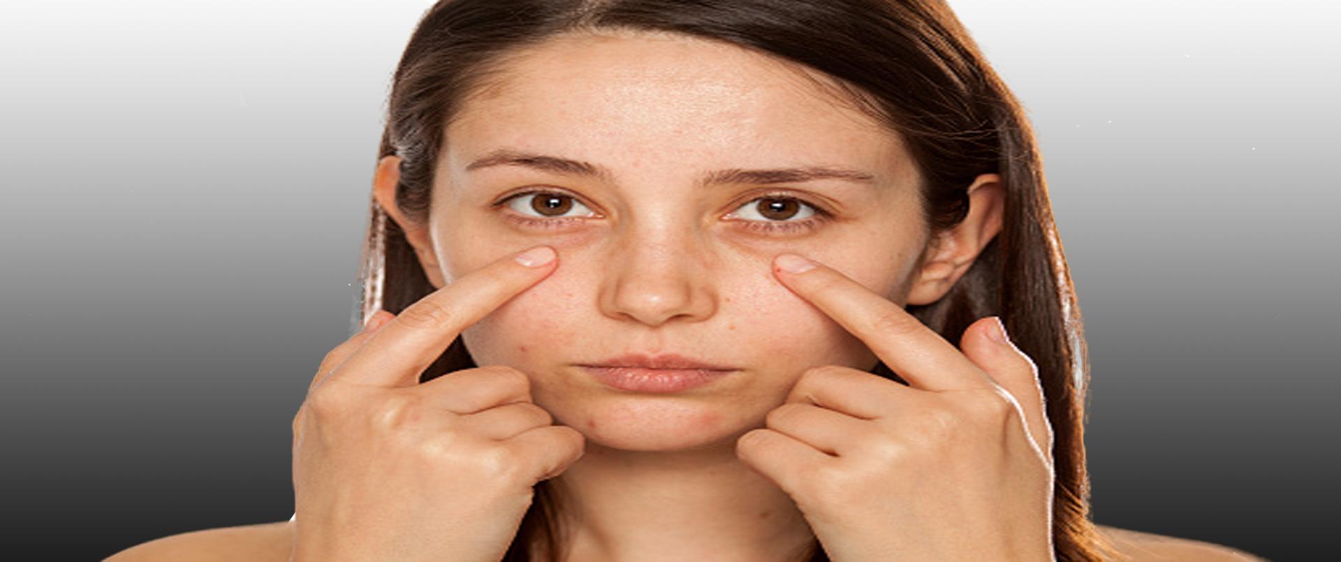 Dark Circle Treatment Affordable Aesthetic Clinic in Dubai Laser