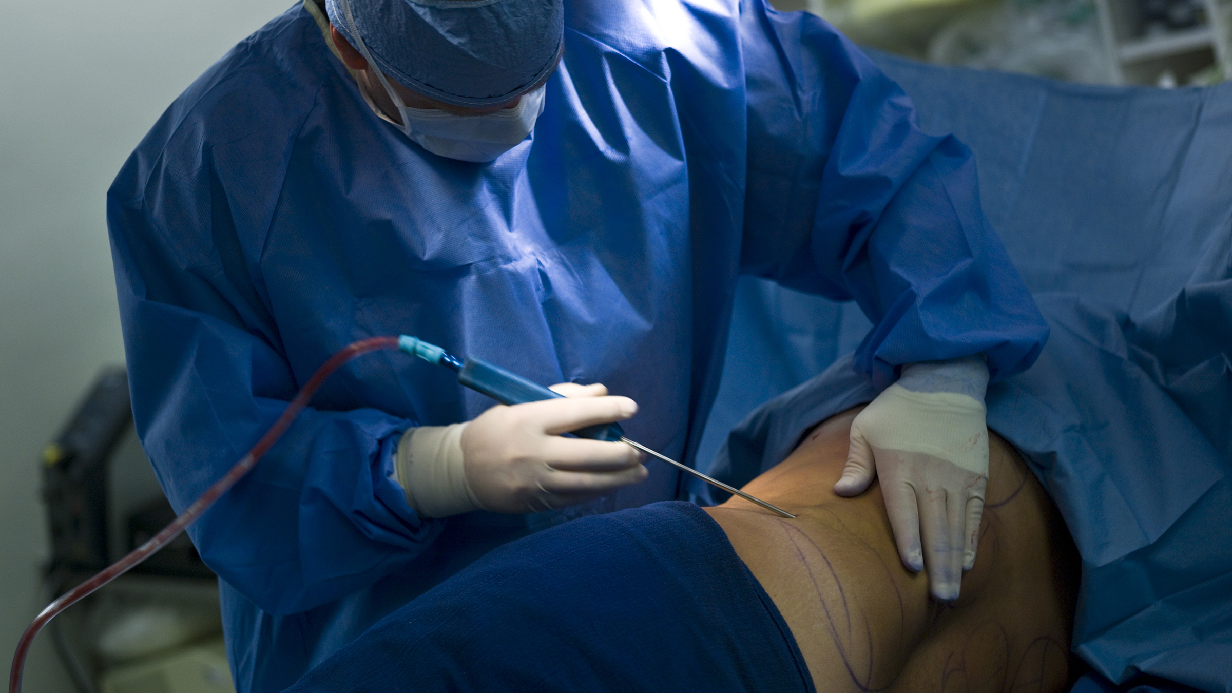 Dubai Liposuction A Comprehensive Guide Dubai Liposuction