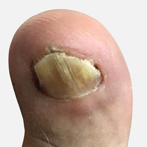 Fungal Nail Removal Dubai Podiatry Centre