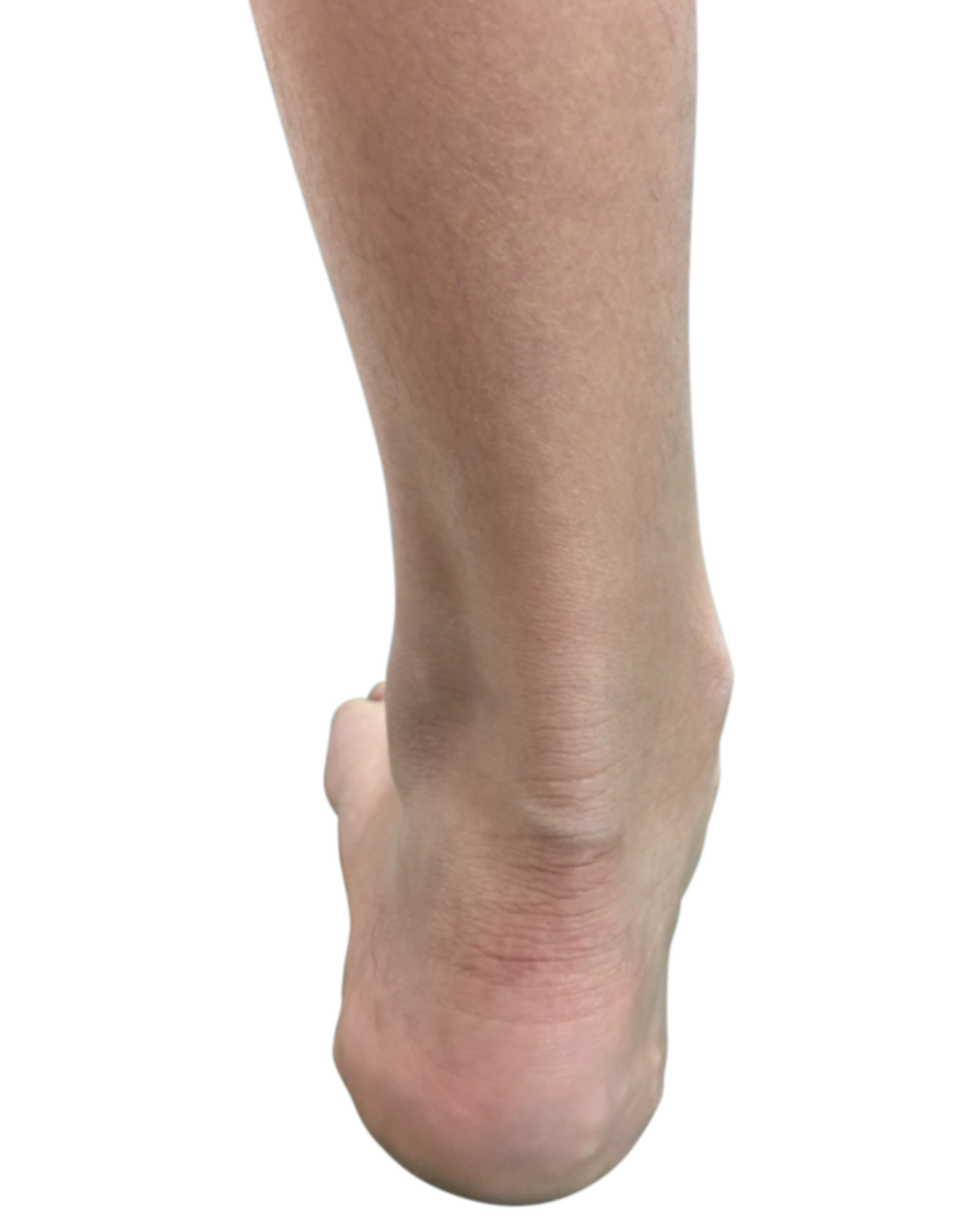 Ankle alignment causing flat feet Dubai Podiatry Centre