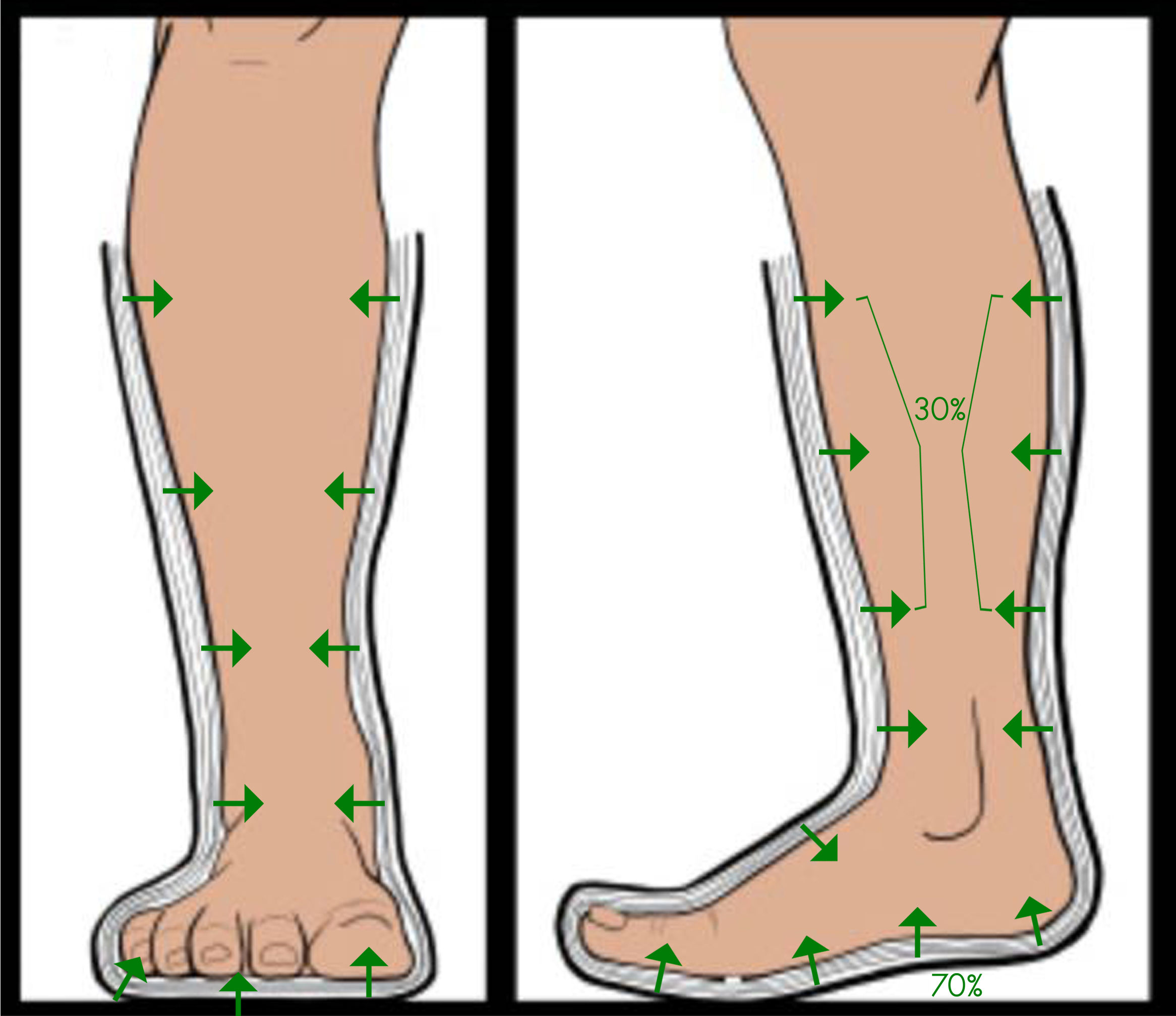 Reducing pressure on the foot ulcer and wound Dubai Podiatry Centre
