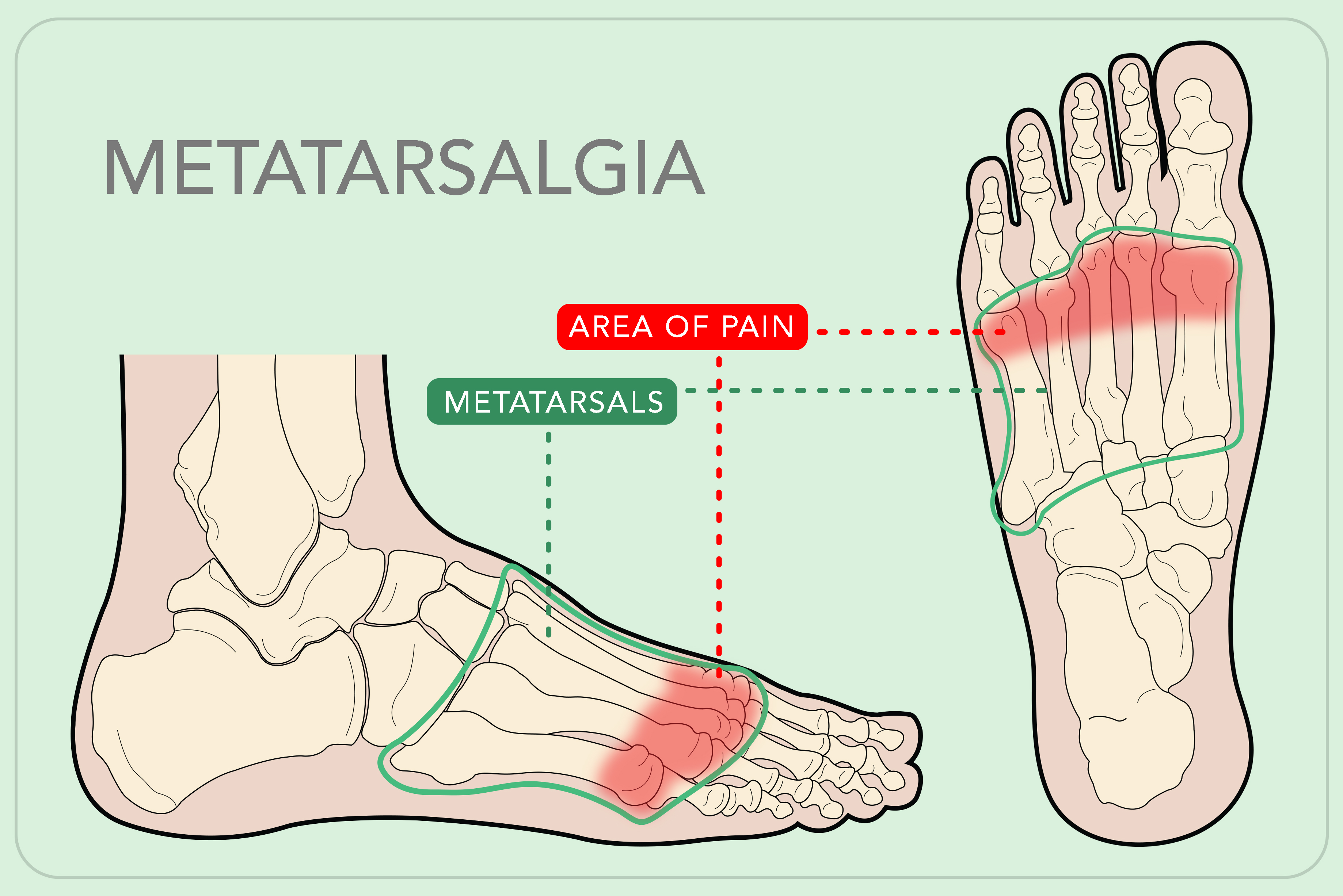 Foot Talk Fridays Metatarsalgia Dubai Podiatry Centre