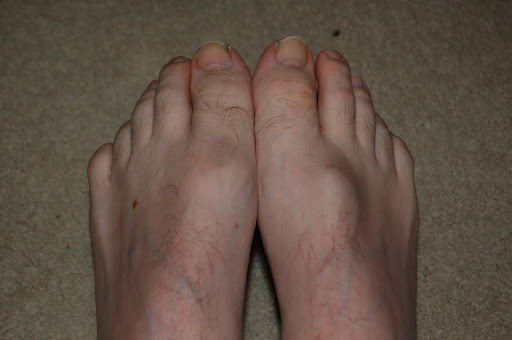 I finally get the bump on my foot taken care of Duff Happenings