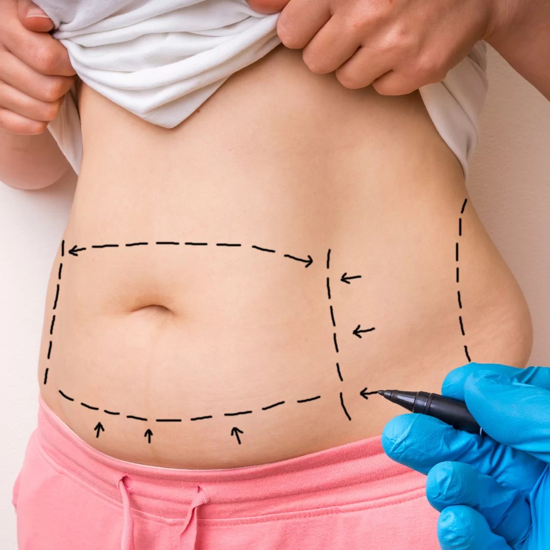Lipo Enzimática Brasilia Duohaus
