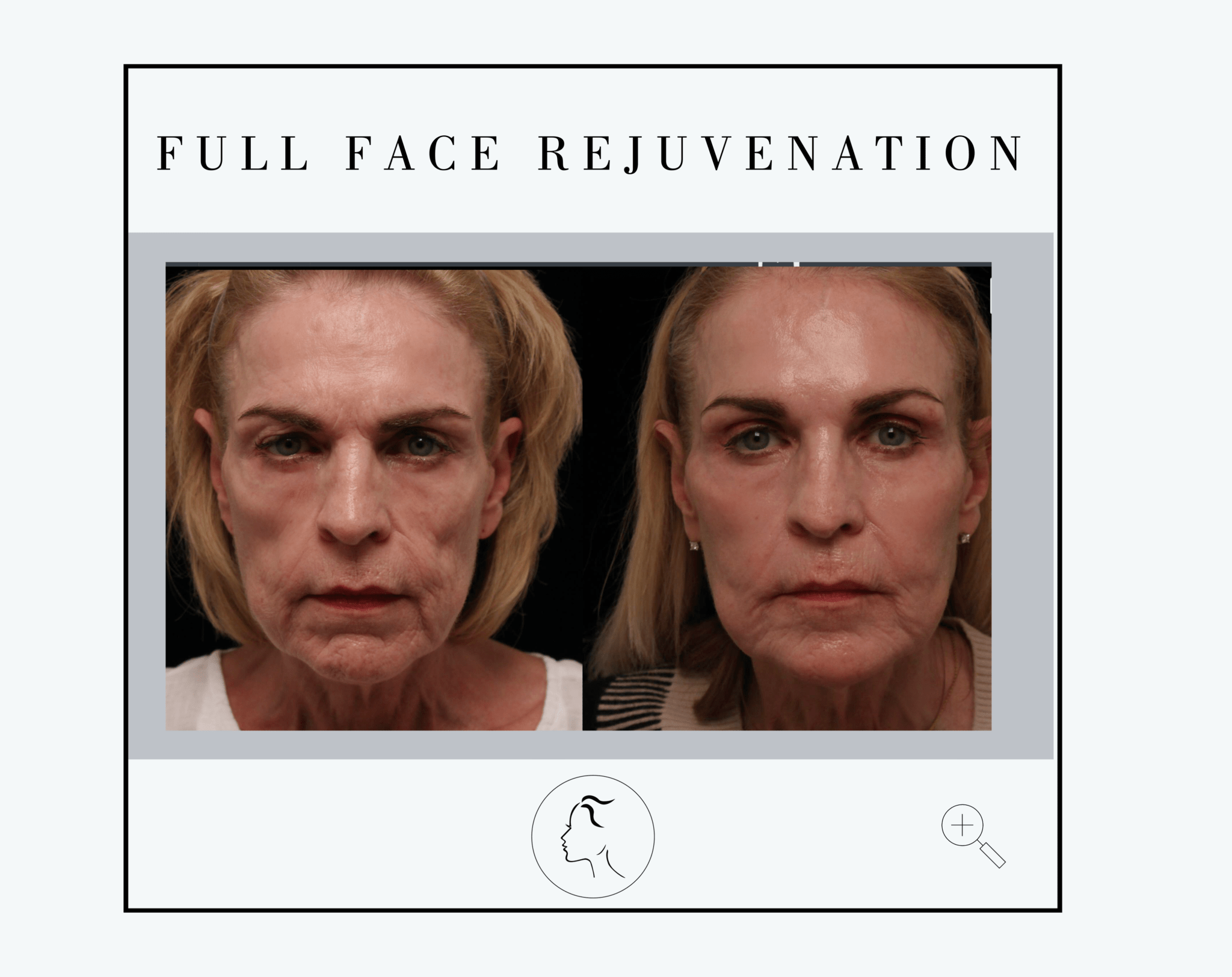 Facial Aesthetic Center Filler Gallery